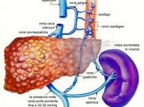 imagine cu cirrosi alcolica